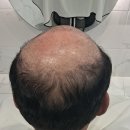 인북로3길 | “이마 주름까지 커버! 전북 익산 노블레스 가발 전후 사진 공개”