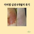 이비엠한의원 | 이비엠 한의원 섭생 176일차 아토피 후기