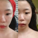 비리야에스테틱 | Before/After
