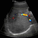 Hepatocellular carcinoma with right portal vein emboli 이미지