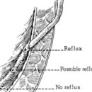 방광요관역류(Vesicoureteral reflux) 이미지