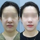 더플러스성형외과 | 미니리프팅후기, 1년 지난 지금 만족도는 몇 %일까 [미니플러스, 플러스업, 성형외과, 후기, 추천]