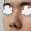 들창코 | 남자코성형 1년 후기 — 들창코 콤플렉스, 진짜로 끝났어요