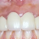 만성 치주염(Chronic periodontitis) 이미지