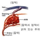 뇌동정맥기형 이미지