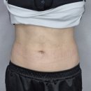 직장인의 여름맞이 첫 바디온다리프팅 : 홍대입구역 피부과 복부온다 후기