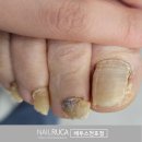 엄지발톱 무좀 초기? 통증없이 해결한 후기