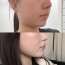 멍피스 | [공지] 신사역 온다리프팅 피부과 2주 후 효과, 붓기, 통증, 멍