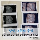 임신13주 : 초음파,증상,입덧,태아,입체초음파 비용,일상