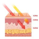 찬솔외과의원 | 스팀다리미 2도화상 - 응급조치 및 화상전문 병원 치료 후기