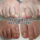 내성발톱발톱무좀관리김수정뷰티 이미지