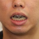 전진 치과의원 | 무턱 턱살, 교정으로 사라지는 이유