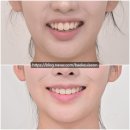 스마일내과의원 | 무턱 비발치 돌출입 개방교합 함입 하악골 자가회전 클리피씨 치료 후기 기록 1년 10개월