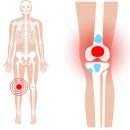 “갑자기 무릎에서 ‘퍽’하는 느낌이…” 반월상 연골판 파열 주의 이미지