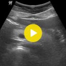 췌장 지방종증 Lipomatosis, Pancreas 이미지