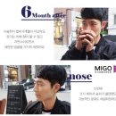 미고성형외과 남자코성형/눈성형 성형모델 후기