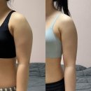 6 | 팔뚝 무한람스 후기 둘레 -6cm 인천 람스 3개월 경과