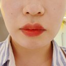 연신내역 | 연신내역 피부과 후기 이중턱 제거 슈링크 추천