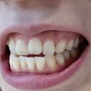 더하얀의원 | 반포치과 이을치과의원 스켈링 치아미백 후기