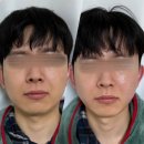 큐어플렉스 고주파 내돈내산 5개월 사용후기