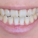 다물 | 절단교합 교정 완료 1년 후 후기