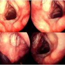 후두암(Larynx cancer)| 이미지
