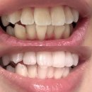 뉴욕100세치과의원 | 강남 치아미백 가격 가장 저렴한 곳 신사역 레브치과 내돈내산 3회 한 달 유지 후기