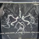 베드로신경외과의원 | 리더스 헬스케어 건강검진 MRA결과 15mm 뇌동맥류 발견/검진 후 13,14일 뒤 결과지 수령/뇌동맥류 전조...