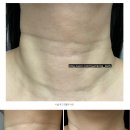 흥선천 | 청담 목주름 디어넥주사 내돈내산 후기 불법 게시물 삭제 요청 (의료법 제56조 제1항 위반) 비공개 조치