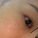 편평사마귀, 주근깨, 잡티 레이저 내돈내산 후기 (일주일 경과, 전후 차이)