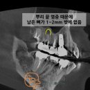 만수동임플란트 뼈가 약해도 가능한 상악동거상술 구강외과 전문의 치료 후기