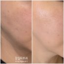 엑셀 | 잠실피부과 엑셀브이레이저후기 프락셀레이저후기