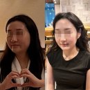쿨시스템 - 남양주시 덕릉로 1103-1 | 신사 압구정 문의원_신상 리프팅 시술 쿨소닉 시술 후기