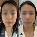 땅콩짐 - 고양시 덕양구 충장로 52 | 송도피부과 올리디아 365 볼륨 3회차 내돈내산｜볼패임·땅콩형 얼굴 개선 후기