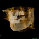 항재식당 | 검단치과 당뇨 임플란트 후기, 어금니 임플란트 후기