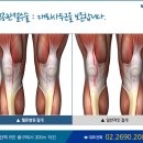 무릎 인공관절수술과 재활운동 이미지