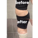 (주)농협사료 부산바이오 | 부산 복부지방흡입 수술 벌써 3kg 감량! 멍, 가려움, 바본 관리 리얼 후기