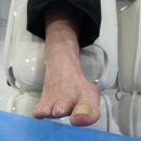 범안로 | 광명시 하안동 노란 발톱 무좀 뽑지 않아도 됐던 병원 치료 후기