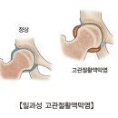 일과성고관절활액막염 (Transient synovitis of hip) 이미지