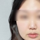 양군피어싱에서 코피어싱하고 2년 지난 후기