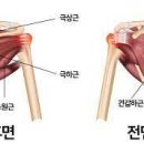 회전근극상근 이상으로오신분!!! 이미지