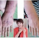 이혈요법 이미지