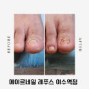에이르네일 | [이수] 무좀발톱 케어 전문샵 에이르네일 레푸스 이수역점 후기