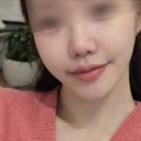 중앙부 | 신사역 피부과 중앙부 리프팅 후기｜이브타이탄 받아본 솔직 경험