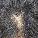 리엔의원 | 연세리엔피부과 여자 가르마탈모관련 방문 후기 -25년 5월 기준