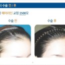 헤어라인교정후기 깨끗해♩