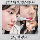 코엔비이비인후과의원 | 강남 코 성형외과 자가늑 코수술 3탄 부목 ,실밥 제거 후기 통증 붓기 직반라인