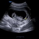 기쁜소식산부인과의원 | 원주산부인과 2, 3회차 진료 후기 (7주차, 10주차)