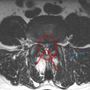 MRI 사진 판독 부탁드립니다. 이미지