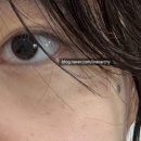 대가농협 우(저단) | (내돈내산) 클라리티 레이저 1회 후기(효과/통증/딱지치료/시술 간격) 진짜 만족스럽다.